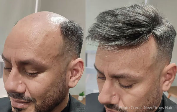 Mens non-surgical hair replacement systems. photo credit New Times Hair